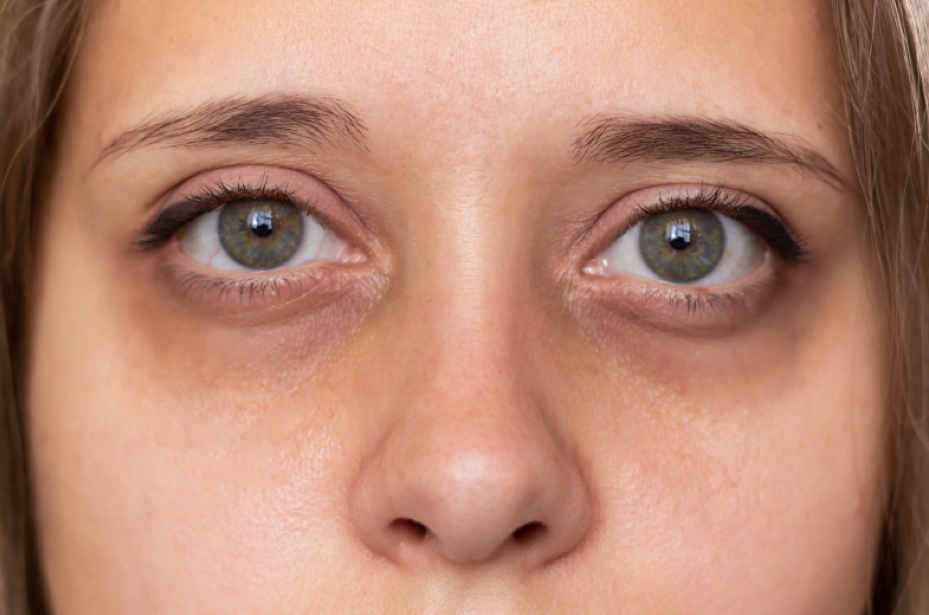 What should you do if you have blue circles under your eyes?