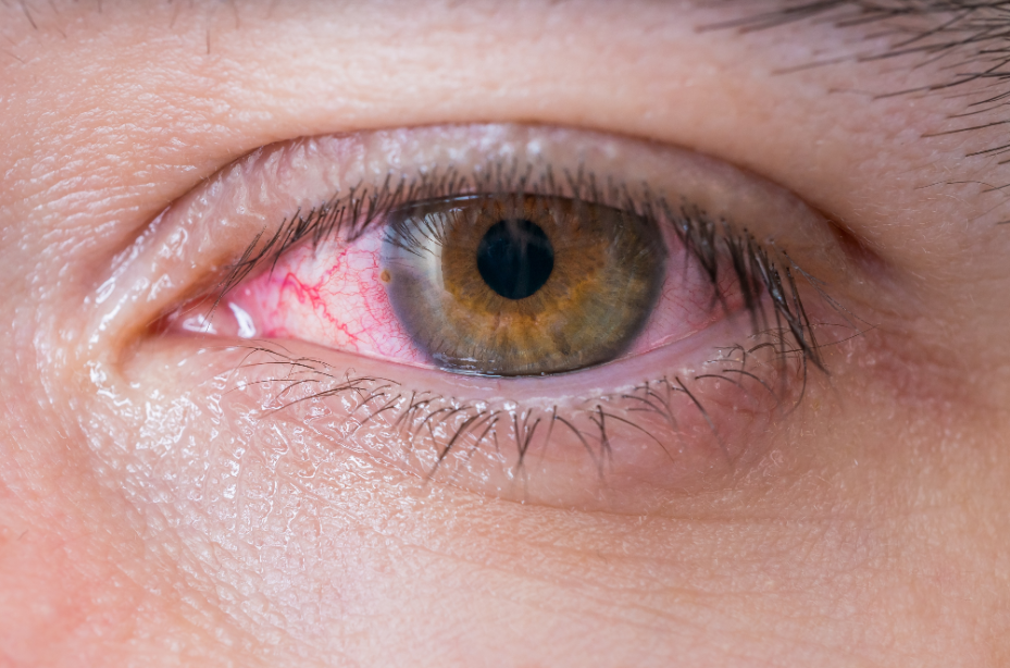 How can you identify nutrient deficiencies by the condition of your eyes?